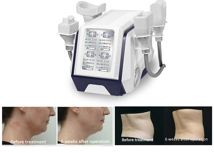 Cuerpo portátil de 360 Cryolipolysis que adelgaza la máquina 1000W para la pérdida de peso ardiente gorda